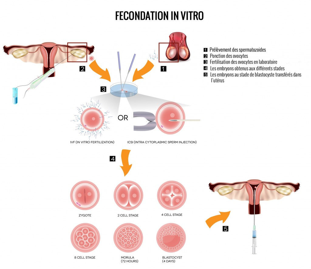 Schéma de la fécondation in vitro